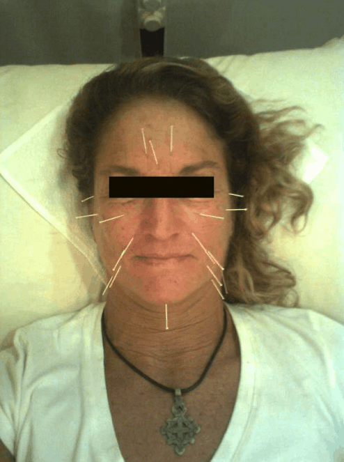 facelift 5 Elements Natural Medicine